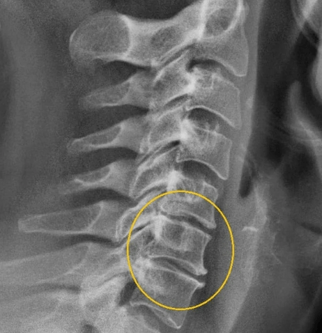 τραχηλική οστεοχονδρία